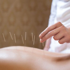 Dry Needling with Stimulation